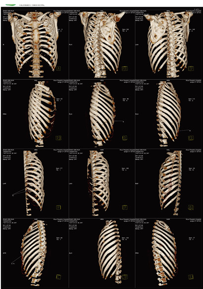 醫用CT膠片-肋骨