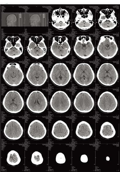 醫用CT膠片-頭CT